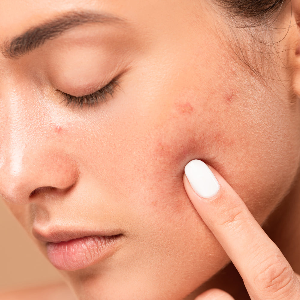 Best_Acne_Treatments