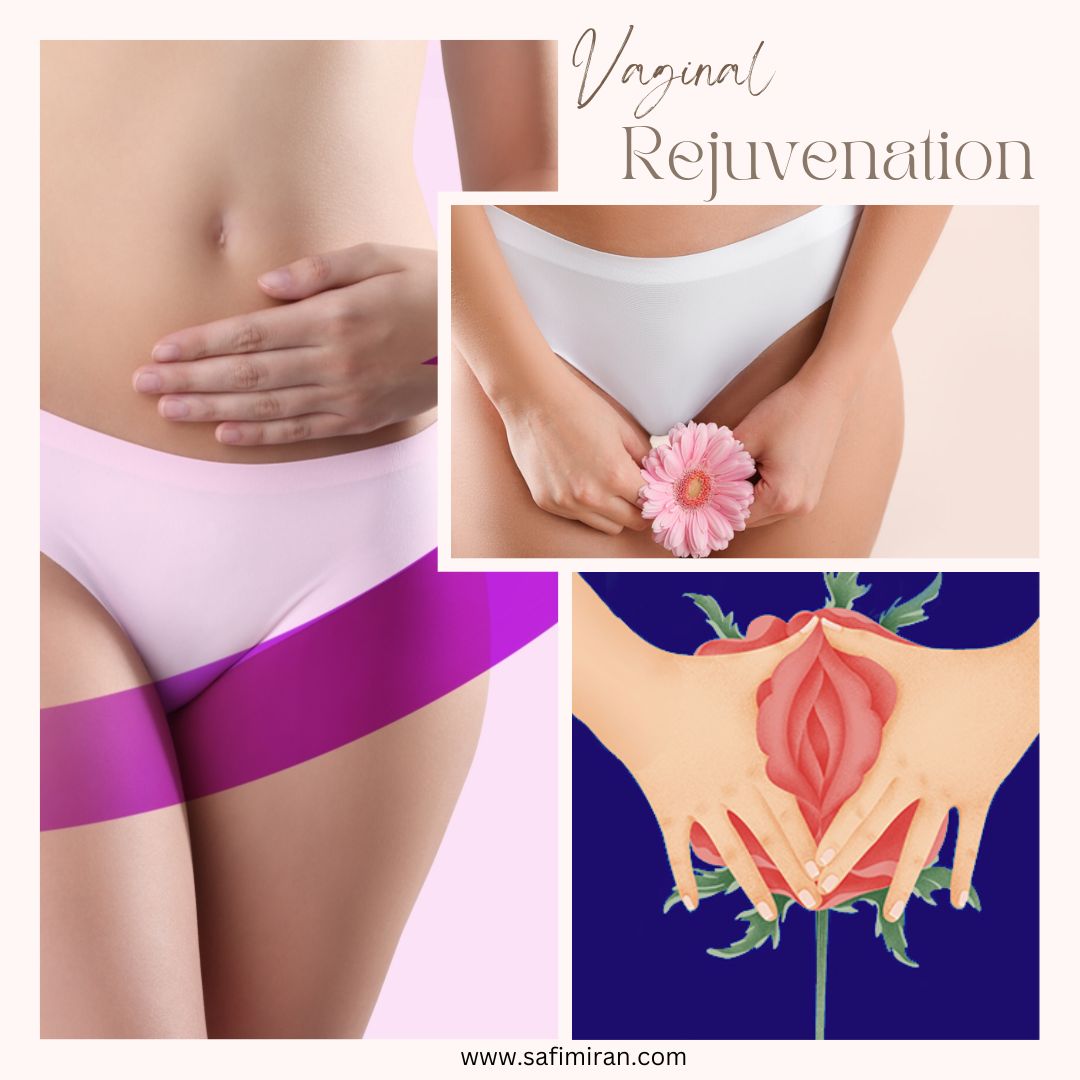 Vaginal Rejuvenation (1)