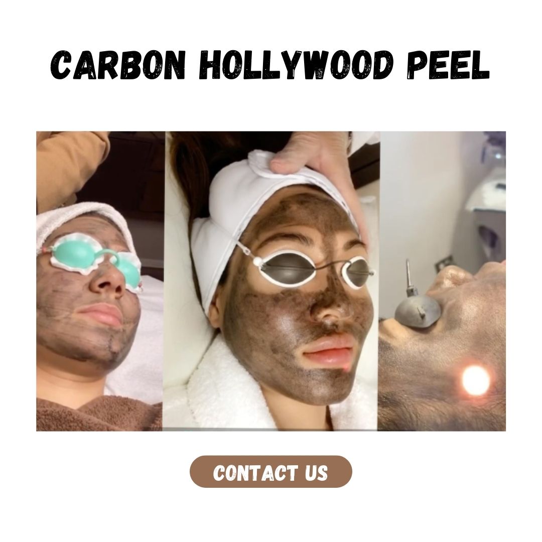 Carbon Hollywood Peel