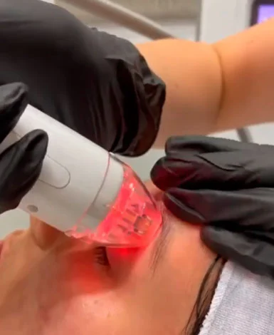 Microneedling in Las Vegas, NV