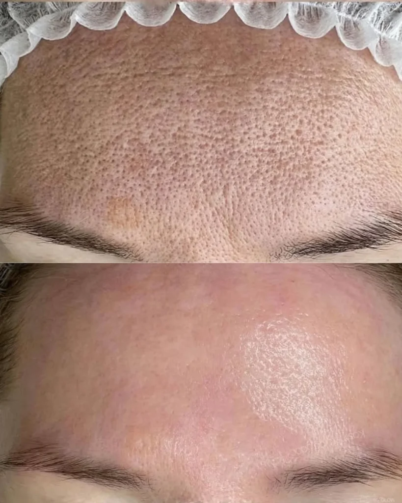 RF Microneedling Treatment | Safi Miran Med Spa Microneedling before and after results – smoother skin texture and reduced wrinkles