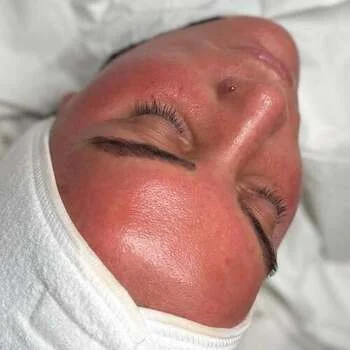 Microneedling vs RF Microneedling comparison results